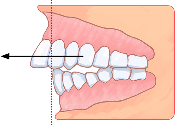 出っ歯 上顎前突 の矯正治療 九段下スターデンタルクリニック 歯並び矯正歯科